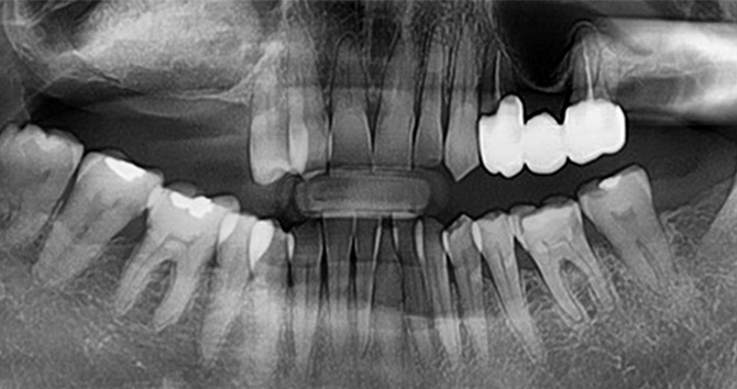 상악동거상술 증례1 After